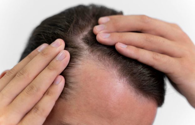 Alopecia y Baricitinib: un nuevo paso en el tratamiento de la pérdida de cabello