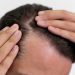 alopecia baricitinib luda partners